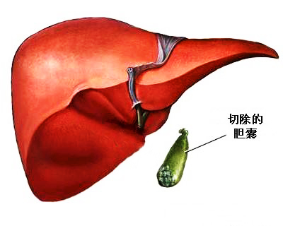 因胆囊结石,胆囊炎,行腹腔镜胆囊切除术,术后恢复正常饮食.