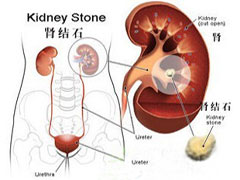<em>肾结石</em>的早期<em>症状</em>是<em>什么</em>样的_<em>肾结石症状</em>_云
