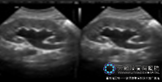 肾结石是怎样引起的呢 56_111213144552_1.png