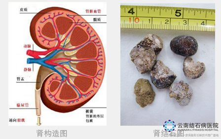 <em>女性肾结石症状</em>主要有哪些_肾结石<em>症状</em>_云南