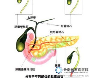 结石性胆囊炎是如何形成的_结石性胆囊炎常识