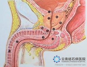 尿道结石的特征是什么