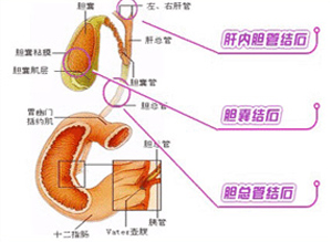 <em>胆囊结石怎么治疗</em>最有效_胆囊结石<em>治疗</em>_云南
