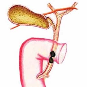 胆囊切除有什么后遗症