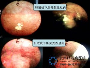 多发性胆囊息肉会恶变吗