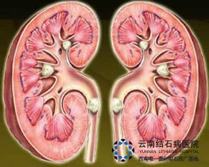 <em>肾结石</em>会引起腰酸吗_<em>肾结石症状</em>_云南结石病