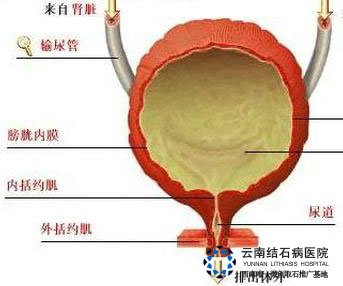 肾结石是怎样形成的怎么治疗 70-12092G531363J.jpg