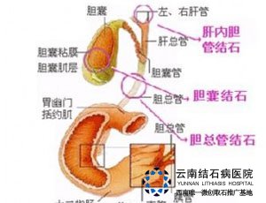 右肝内胆管结石治疗