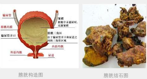 膀胱结石的危害与治疗_膀胱结石危害_云南结
