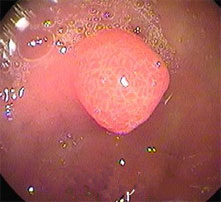 胆囊息肉症状_云南结石病医院_肾结石_胆结石