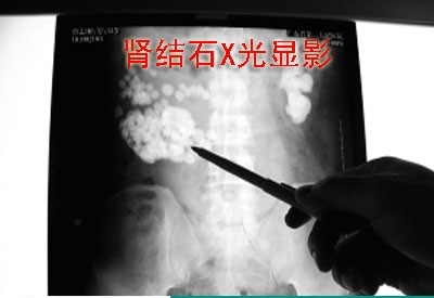 起底肾结石预防方法