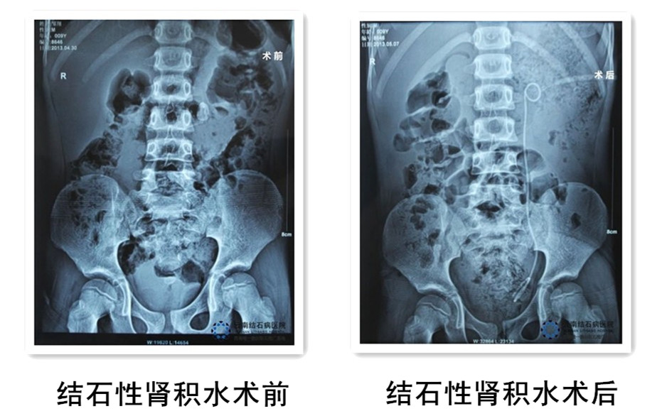 肾结石一般多久复发一次 96-140621164015S3.jpg