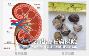 昆明肾结石手术多少钱