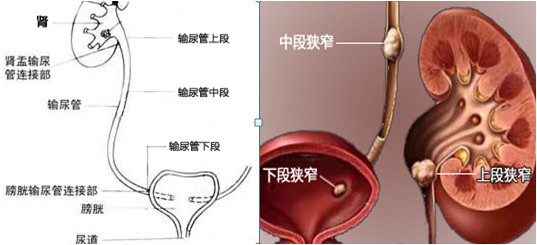 右输尿管上段结石并右肾积水