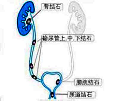 输尿管下段<em>结石症状</em>_云南结石病医院_<em>肾结石</em>