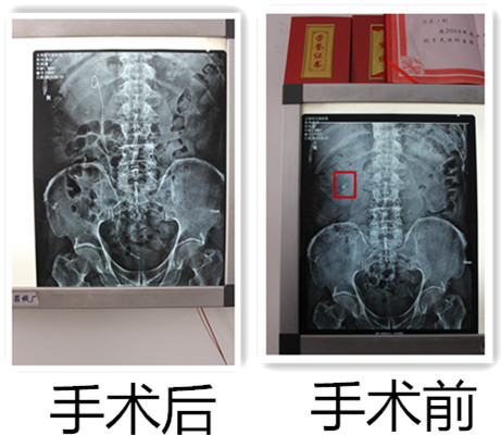 独肾患者成功保肾取石