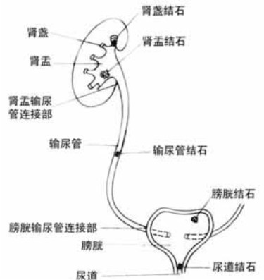 尿道结石严重的危害有哪些？(图1)