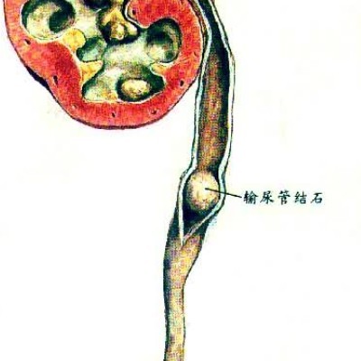 造成男性输尿管结石的原因有哪些?