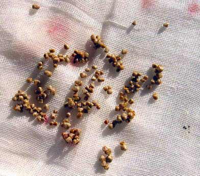 【百科】胆固醇性胆囊结石