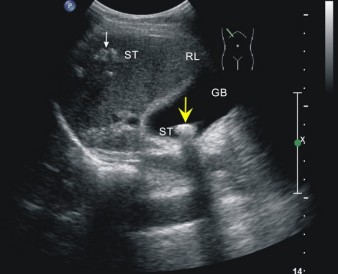 胆囊结石伴胆囊炎_云南结石病医院_肾结石_胆结石_保胆保肾取石-亚洲专业治疗结石病的医院