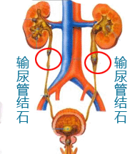输尿管结石的并发症有哪些方面