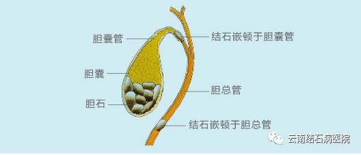 9.1胆囊健康日!云南结石病医院胆囊疾病义诊义检活动邀请您参与
