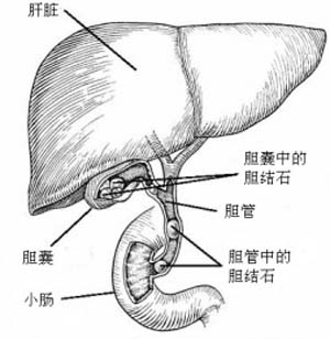 胆结石不仅引起了慢性胆囊炎,还影响到了你的肝脏功能