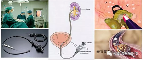 体外碎石后有砂样结石排出就是好了吗?